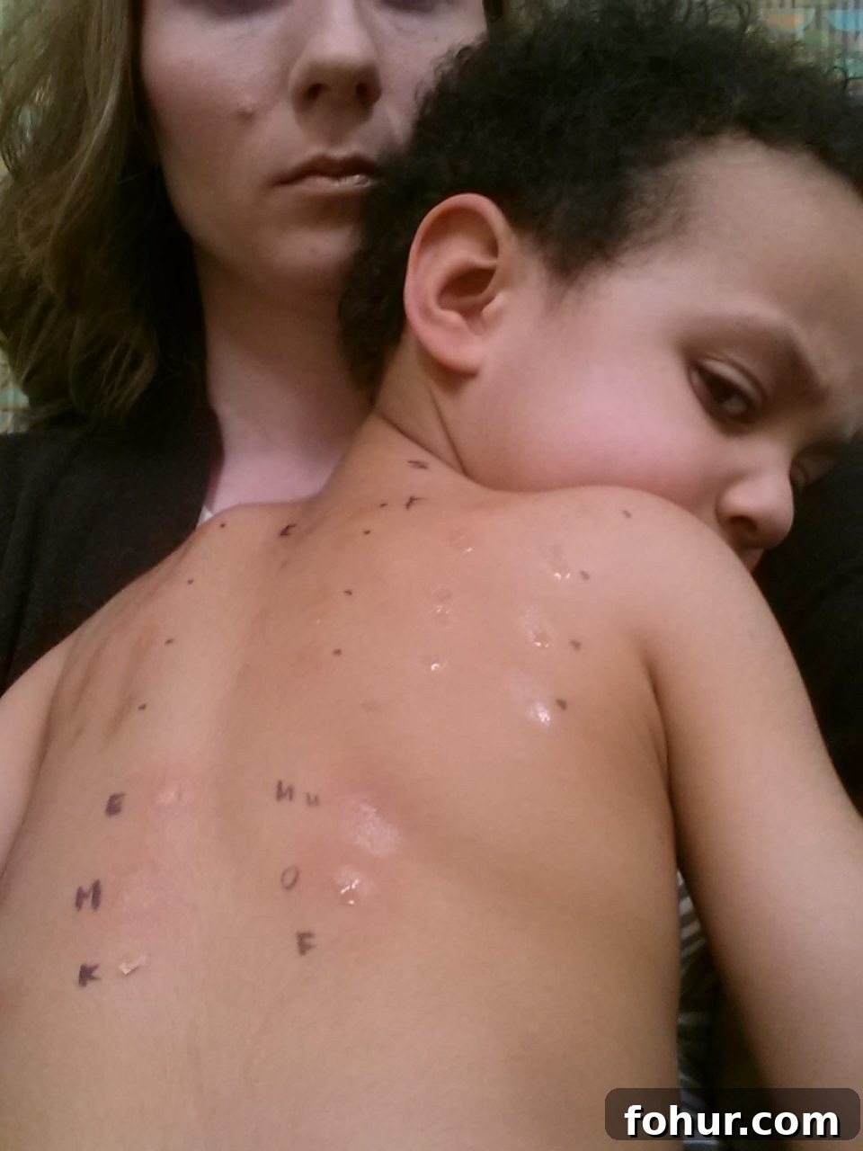Eosinophilic Esophagitis (EOE): A Mother and Son's Journey 4 eosinophilic esophagitis in children